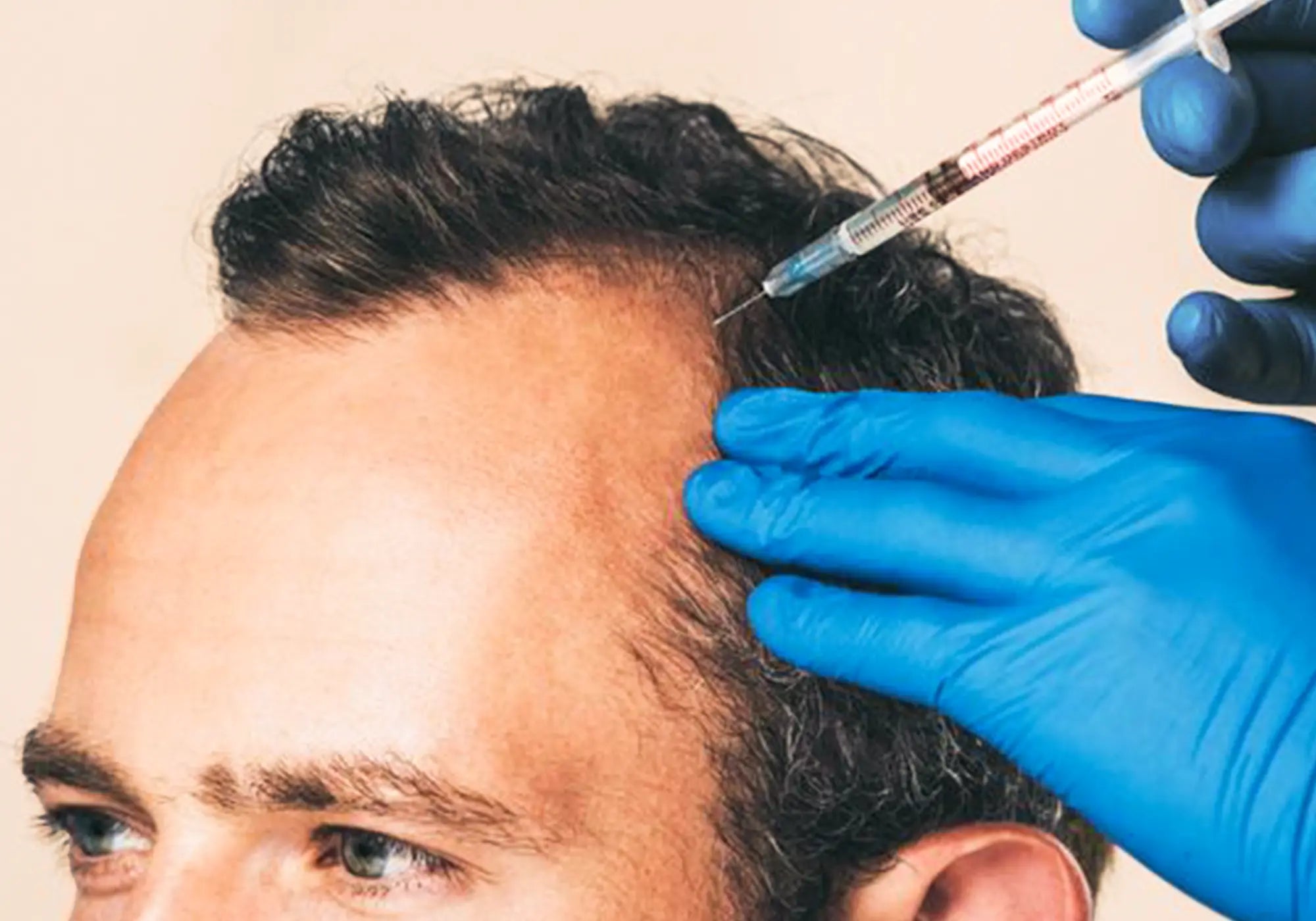 Crown Luxe Regeneration в центре омоложения Healthi-Life Longevity - роскошная терапия стволовыми клетками при сильном выпадении волос и современное омоложение волос